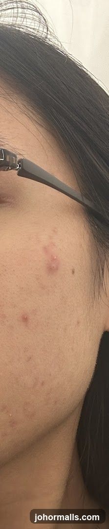 Close-up of a person's face with acne