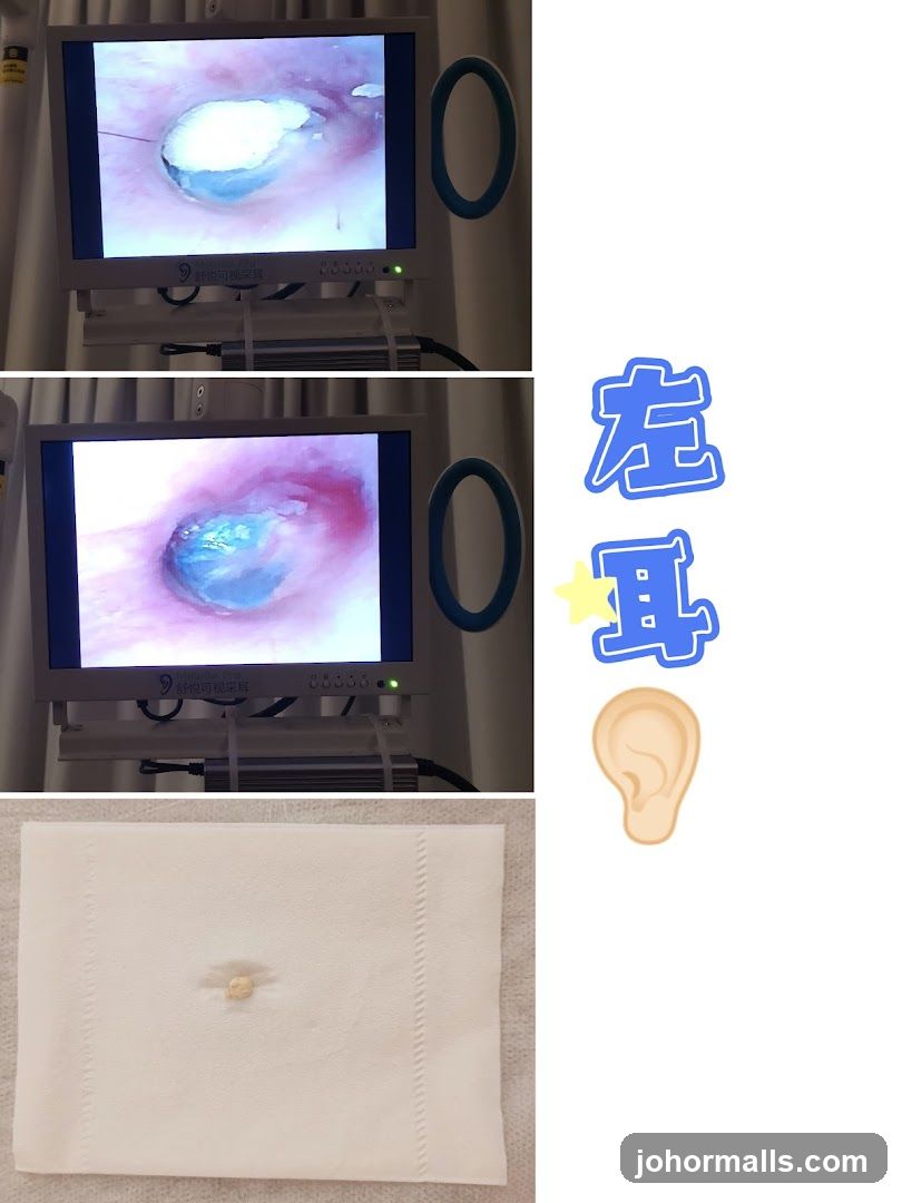 Earwax Removal