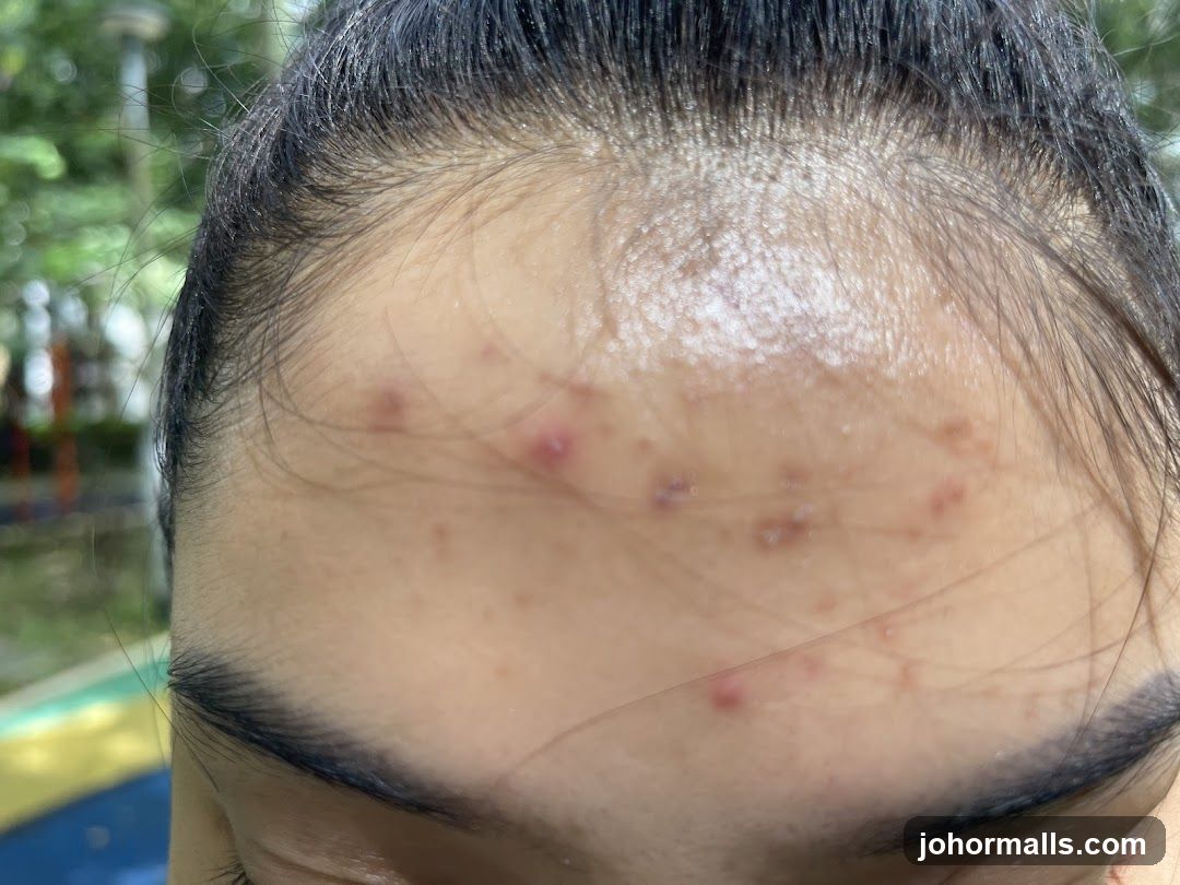 Forehead with Acne