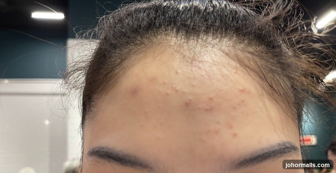 Forehead with Acne