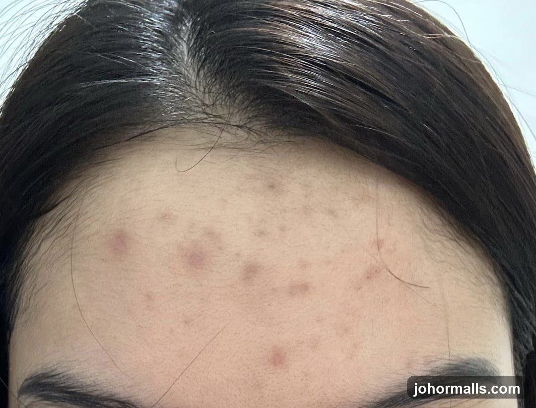 Forehead with Acne