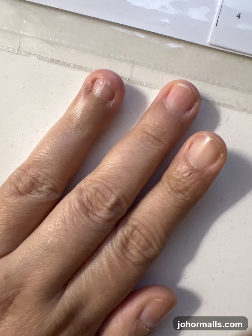 Fingers with bitten nails