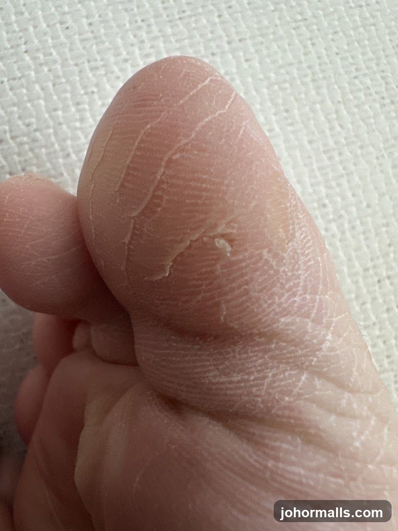 Close-up of Dry, Cracked Skin on a Foot