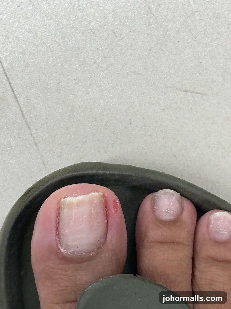 Close-up of Toes with a Blister
