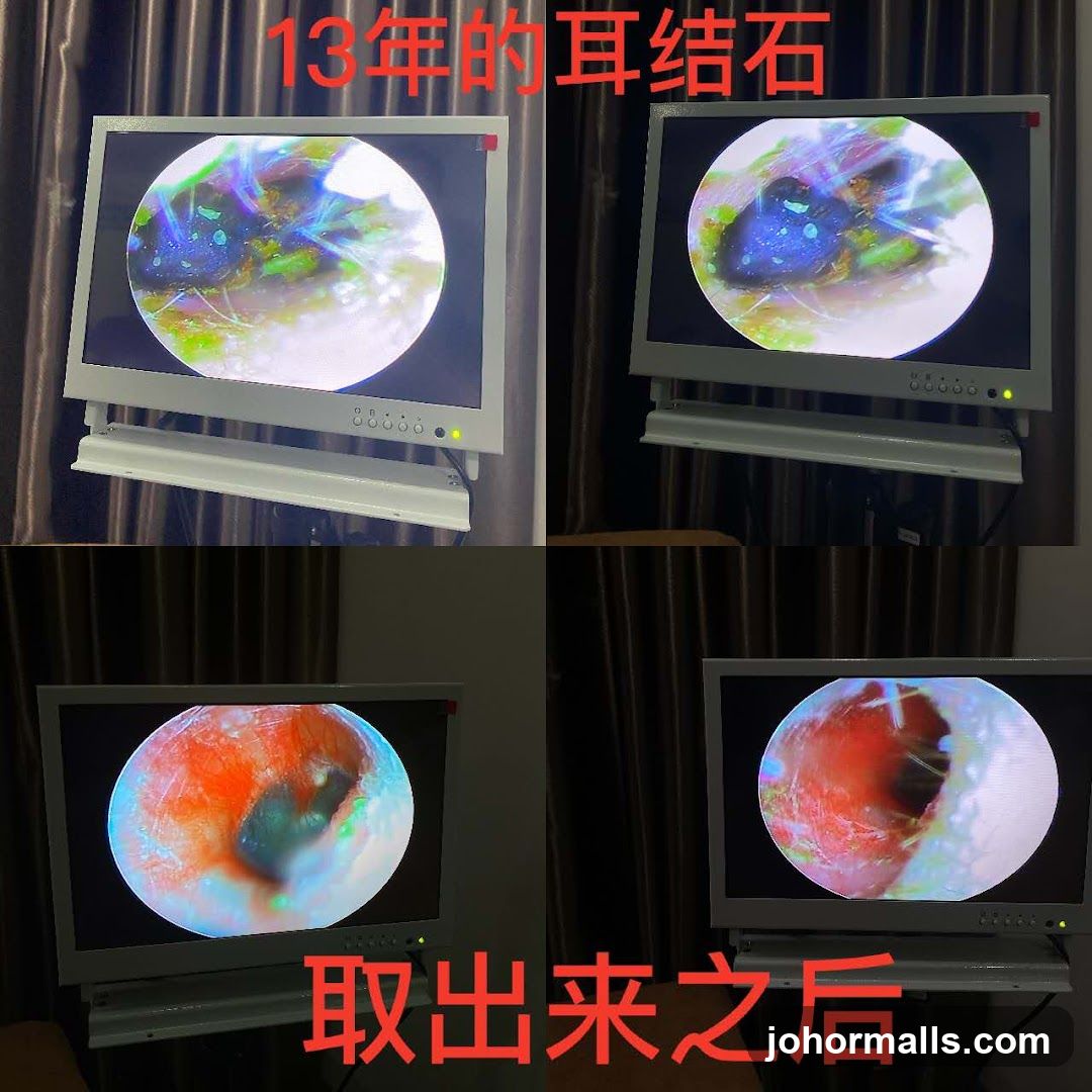 Medical Endoscopic View of Ear Wax Removal